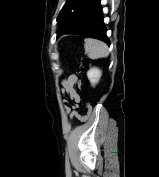 File:Clear cell renal cell carcinoma (Radiopaedia 85006-100539 G 11).jpg