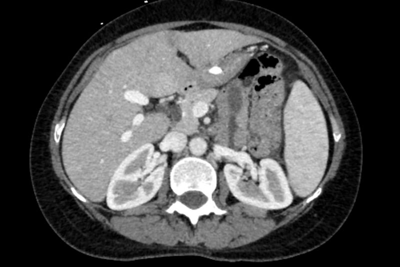 File:Closed loop small bowel obstruction (Radiopaedia 71211-81508 A 24).jpg