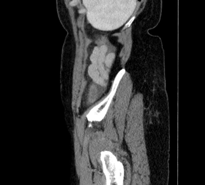 File:Closed loop small bowel obstruction (Radiopaedia 71211-81508 C 155).jpg