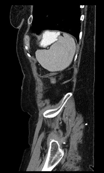 File:Closed loop small bowel obstruction - adhesions (Radiopaedia 59269-66611 C 19).jpg