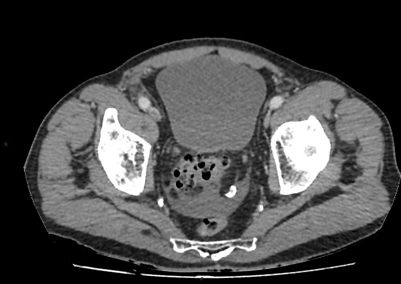 File:Closed loop small bowel obstruction with ischemia (Radiopaedia 84180-99456 A 106).jpg