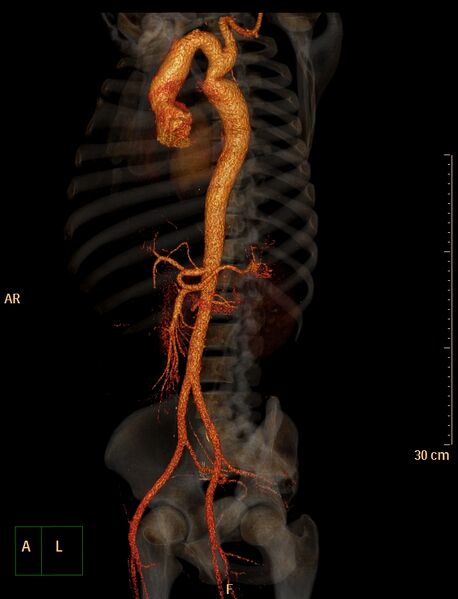 File:Coarctation of the aorta (Radiopaedia 49784-55050 3D VRT 19).jpg