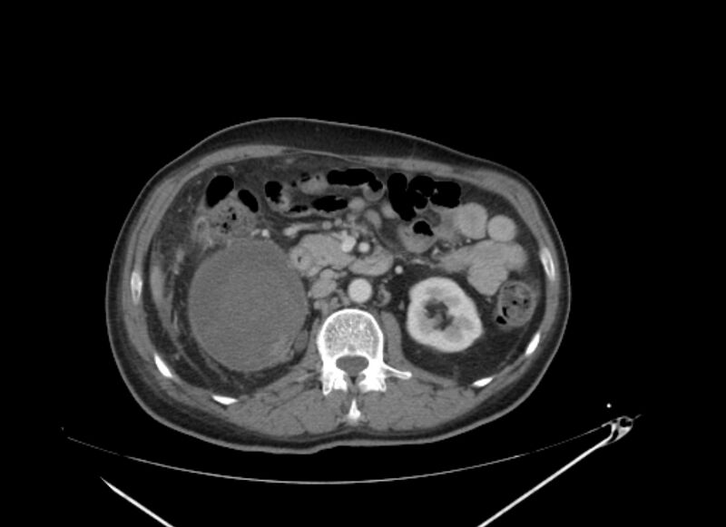 File:Colon cancer mimicking renal cell carcinoma (Radiopaedia 28986-29335 C 32).jpg