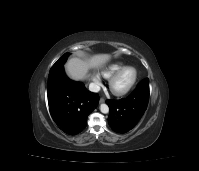 File:Colonic diverticulosis (Radiopaedia 22934-22957 A 4).jpg