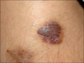Two dusky red to brown plaques with surrounding ecchymotic macular rings on the left knee