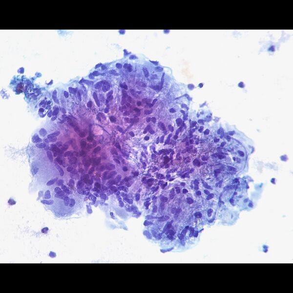 File:Liver granuloma (cytology) (Radiopaedia 77990).jpeg