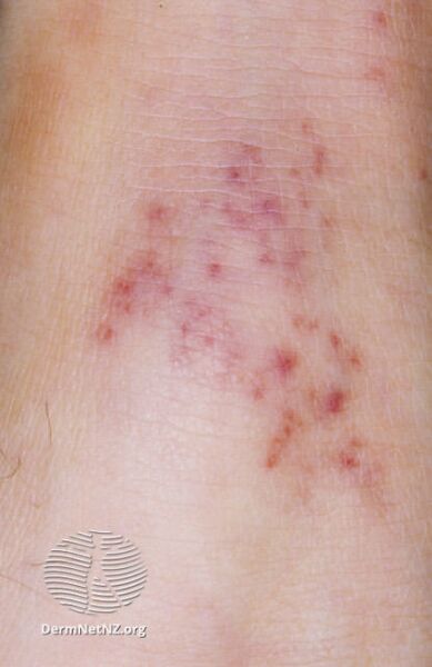 File:Meningococcal disease (DermNet NZ meningo-close).jpg