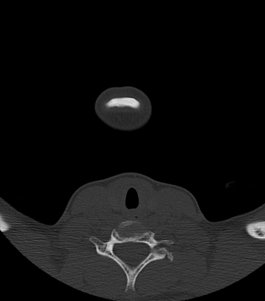 Nasoorbitoethmoid fracture (Radiopaedia 90044-107205 Axial bone window 6).jpg