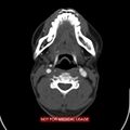 Nasopharyngeal carcinoma recurrence - skull base destruction (Radiopaedia 29107-29491 A 21).jpg