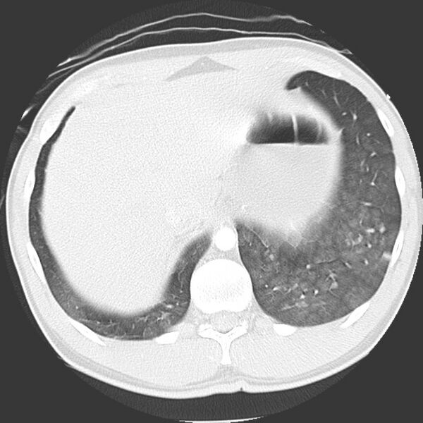 File:Near drowning pulmonary edema (Radiopaedia 16868-16591 Axial lung window 48).jpg