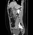 Necrotizing pancreatitis (Radiopaedia 23001-23031 C 27).jpg