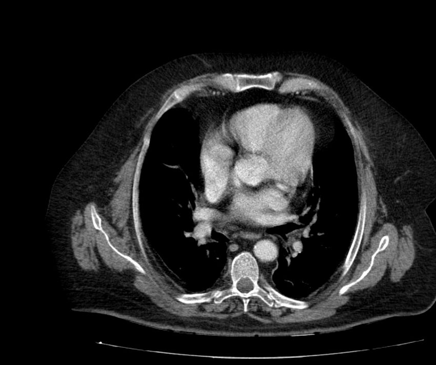 Nephroptosis with inguinal hernia containing perirenal fat (Radiopaedia 56632-63391 C 12).jpg