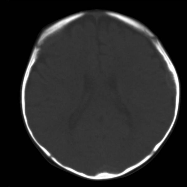 File:Neuroblastoma with skull metastases (Radiopaedia 30326-30958 Axial bone window 13).jpg