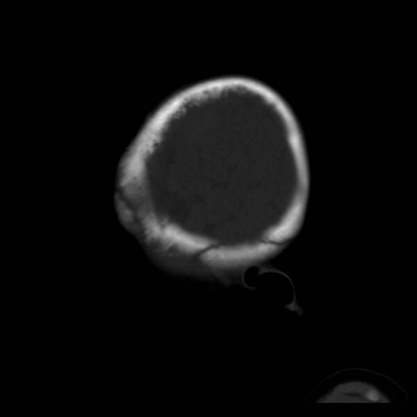 File:Neuroblastoma with skull metastases (Radiopaedia 30326-30958 Sagittal bone window 40).jpg