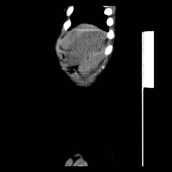 File:Neuroblastoma with skull metastases (Radiopaedia 30326-30960 B 45).jpg