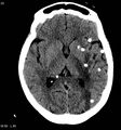 Neurocysticercosis (Radiopaedia 7773-8596 non-contrast 6).jpg