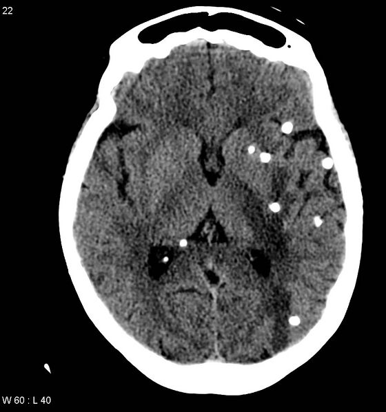 File:Neurocysticercosis (Radiopaedia 7773-8596 non-contrast 6).jpg