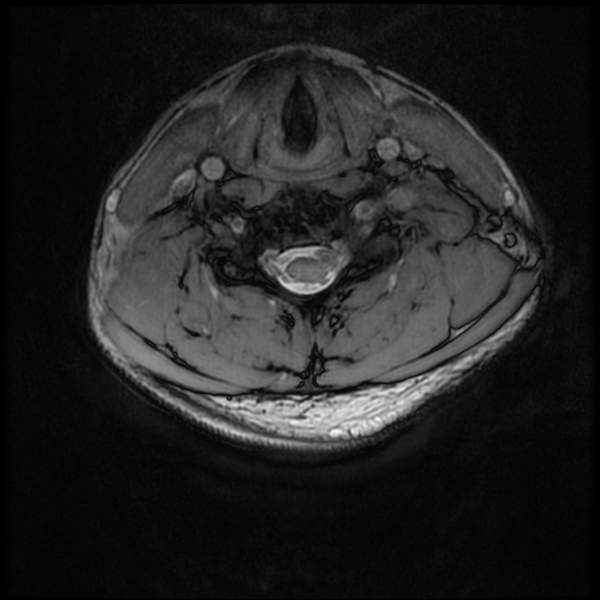 File:Neurofibromatosis type 2 (Radiopaedia 44936-48837 Axial Gradient Echo 15).png