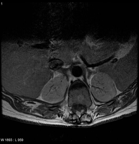 File:Neurofibromatosis type 2 - cranial and spinal involvement (Radiopaedia 5351-7112 Axial T1 C+ 1).jpg