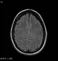 Neurosarcoidosis (Radiopaedia 10930-11351 Axial FLAIR 15).jpg
