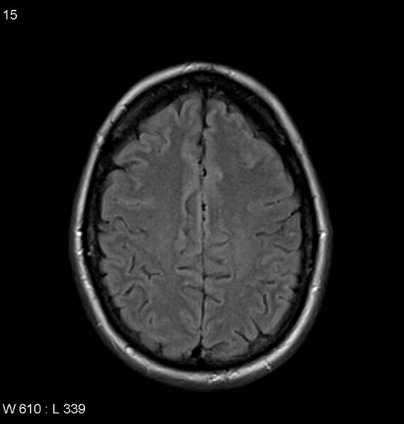File:Neurosarcoidosis (Radiopaedia 10930-11351 Axial FLAIR 15).jpg