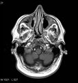 Neurosarcoidosis (Radiopaedia 10930-11351 Axial T1 C+ 2).jpg