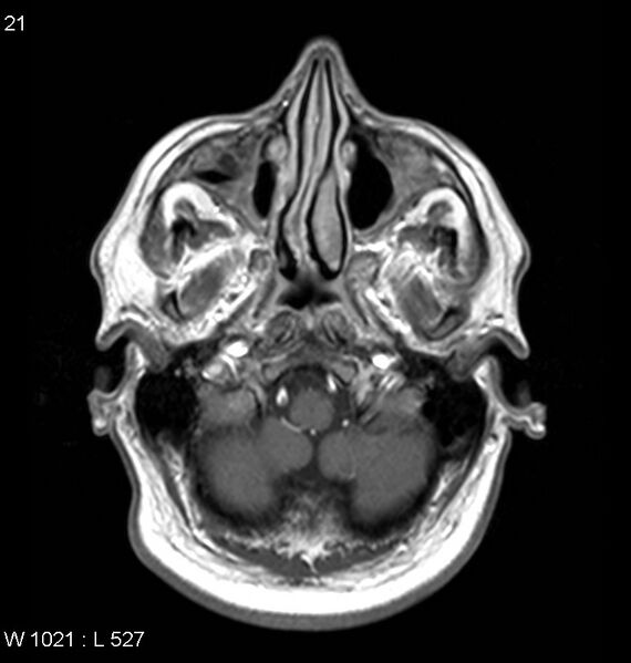 File:Neurosarcoidosis (Radiopaedia 10930-11351 Axial T1 C+ 2).jpg
