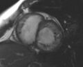 Non-compaction of the left ventricle (Radiopaedia 69436-79314 Short axis cine 151).jpg