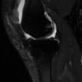 Non-displaced patella fracture (Radiopaedia 15932-15582 Sagittal T2 fat sat 7).jpg