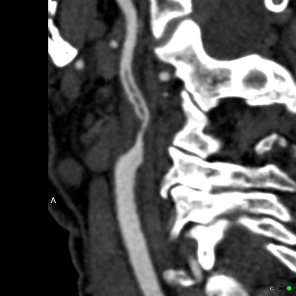 File:Non-occlusive intraluminal internal carotid artery thrombus (Radiopaedia 37751-39658 A 63).jpg