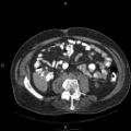 Non Hodgkin lymphoma in a patient with ankylosing spondylitis (Radiopaedia 84323-99624 Axial non-contrast 47).jpg
