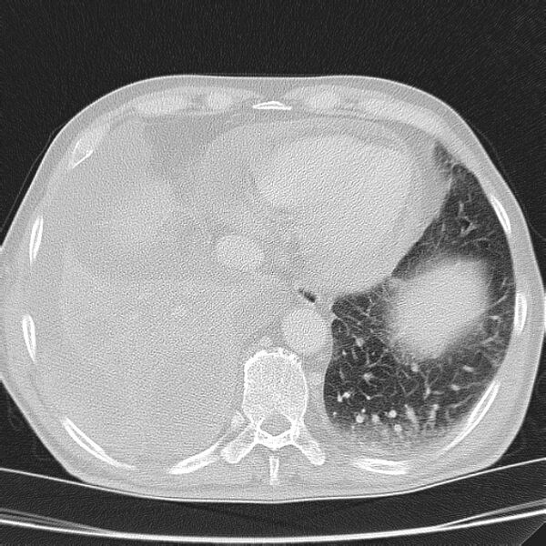 File:Non small-cell lung cancer (Radiopaedia 24467-24769 lung window 42).jpg