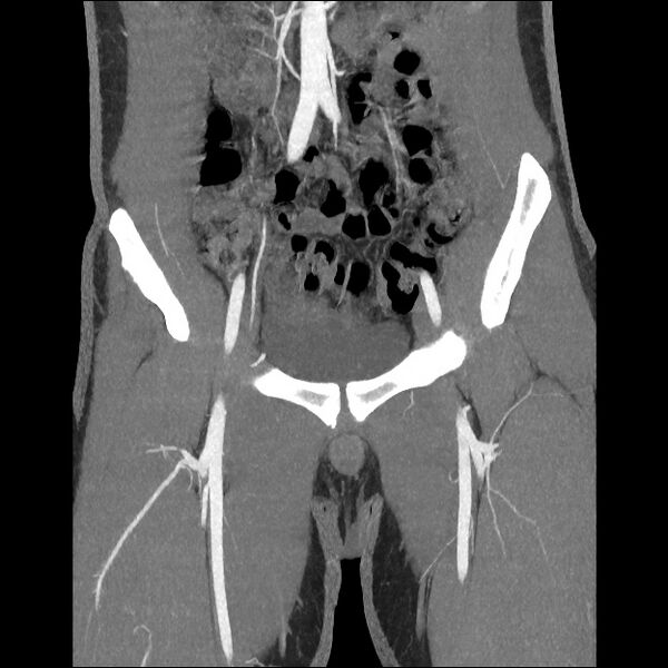 File:Normal CT angiogram of pelvis (Radiopaedia 45390-49430 B 18).jpg
