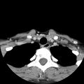 Normal CT of the neck (Radiopaedia 14575-14500 Axial C+ 60).jpg