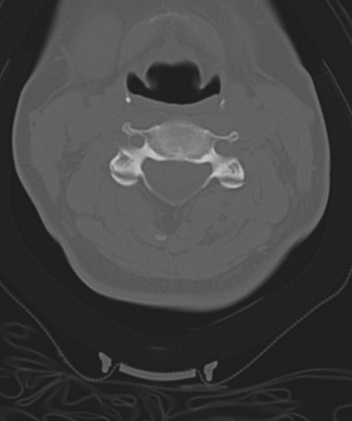 File:Normal cervical spine MRI (including Dixon) (Radiopaedia 42762-45926 Axial bone window 27).png