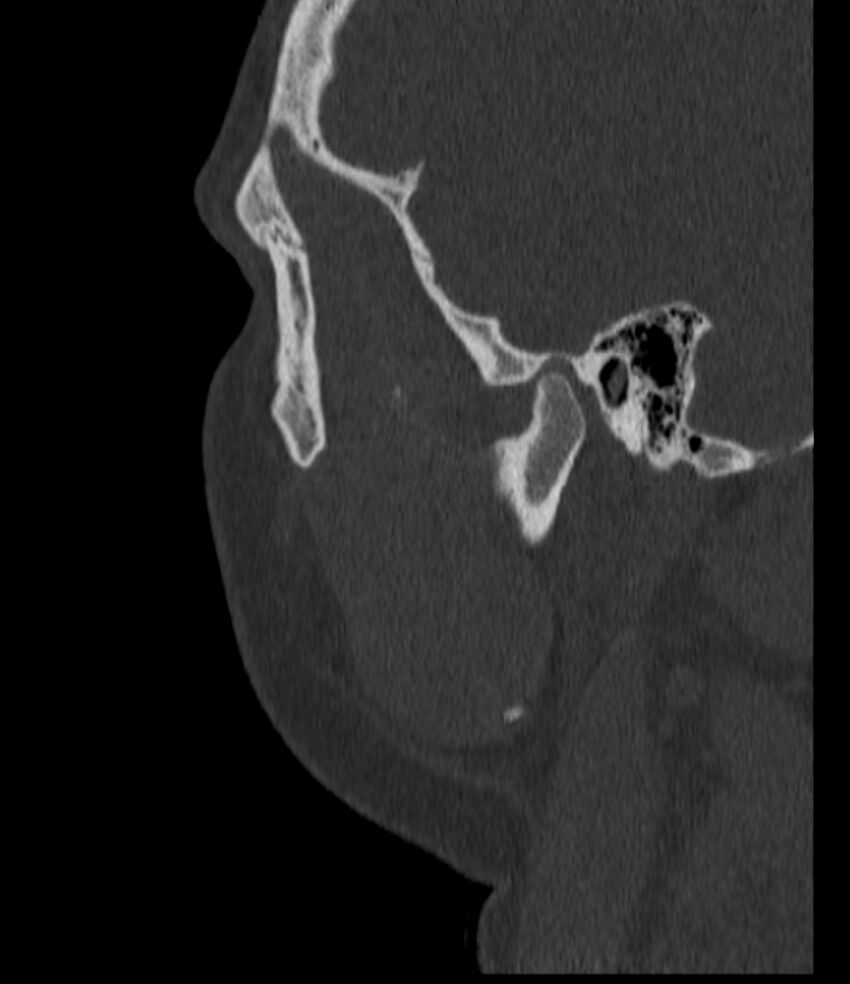 Normal facial bone CT (Radiopaedia 88742-105476 Sagittal bone window 137).jpg
