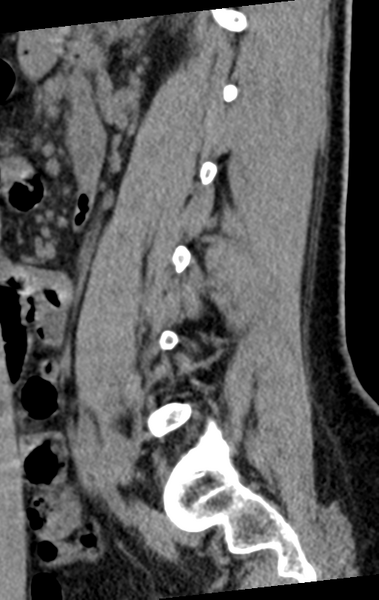 File:Normal lumbar spine CT (Radiopaedia 46533-50986 C 33).png