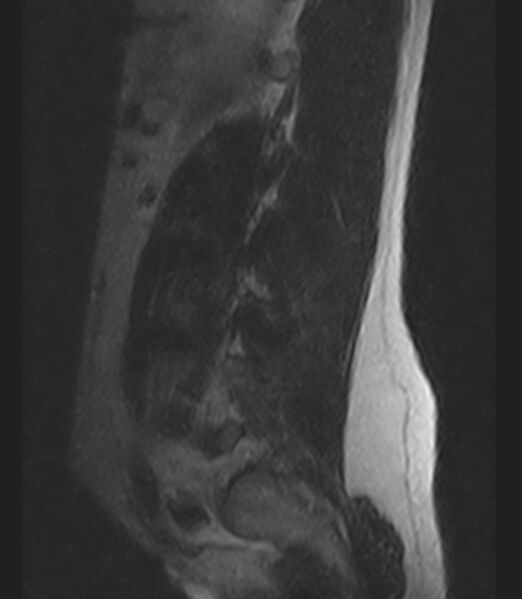 File:Normal lumbar spine MRI - low-field MRI scanner (Radiopaedia 40976-43699 Sagittal T2 11).jpg