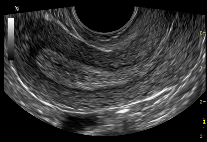 File:Normal pelvic ultrasound - transvaginal (Radiopaedia 31750-32684 B 1).png