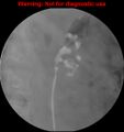 Normal retrograde pyelography of a native and transplant kidney (Radiopaedia 40480-43054 Native kidney 1).jpg