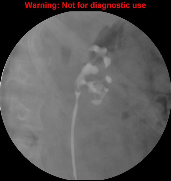File:Normal retrograde pyelography of a native and transplant kidney (Radiopaedia 40480-43054 Native kidney 1).jpg