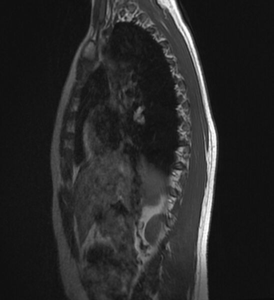 File:Normal thoracic spine MRI (Radiopaedia 41033-43781 Sagittal T1 1).jpg