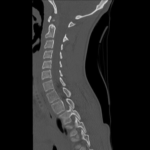 File:Normal trauma spine imaging (age 16) (Radiopaedia 45335-49358 Sagittal bone window 23).jpg
