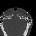 Occipital condyle fracture (Radiopaedia 31755-32691 Axial bone window 5).jpg