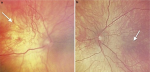 a) Right eye b) left eye show macular hypoplasia arrow with blond retinal background