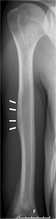 X-ray pneumococcal osteomyelitis