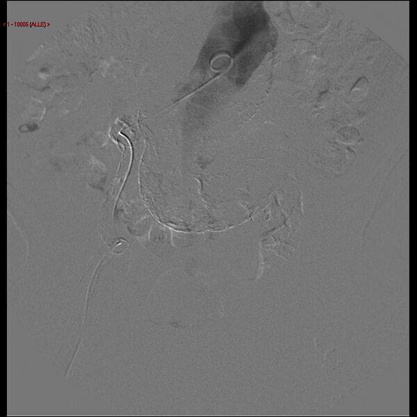 File:Abdominal aortic aneurysm (Radiopaedia 16155-15833 Frontal Aorta 1).jpg