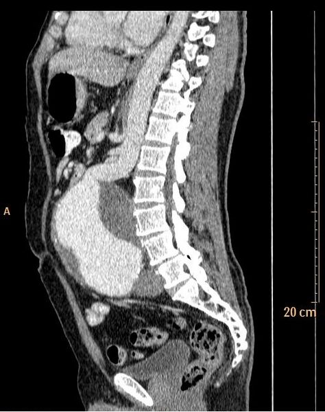 File:Abdominal aortic aneurysm (Radiopaedia 25985-26121 Sagittal C+ arterial phase 12).jpg