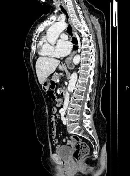 File:Abdominal aortic aneurysm (Radiopaedia 85063-100606 Sagittal C+ arterial phase 41).jpg