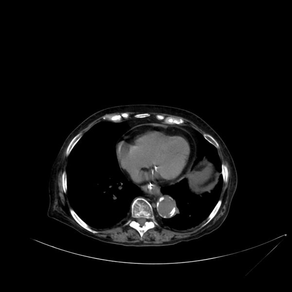 File:Abdominal aortic aneurysm - impending rupture (Radiopaedia 19233-19246 Axial non-contrast 12).jpg